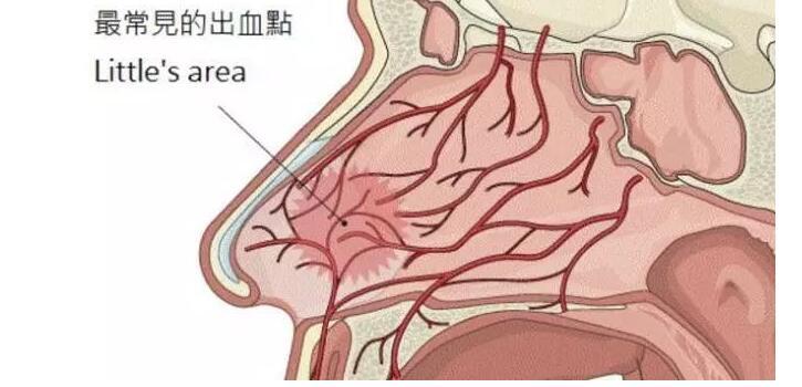 孩子流鼻血你还在让他仰头止血正确的做法是